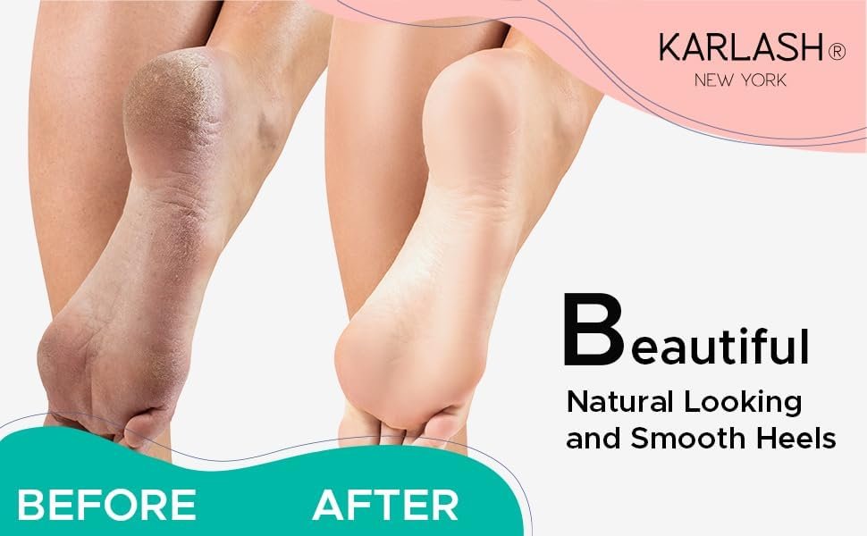 Karlash Callus Remover Gel and Foot Pumice Stone Scrubber Kit 4 oz