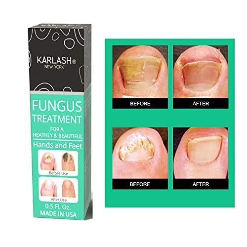 Karlash Finger & Toenail Fungus Treatment (Pack of Two) EXTRA STRONG Made in USA