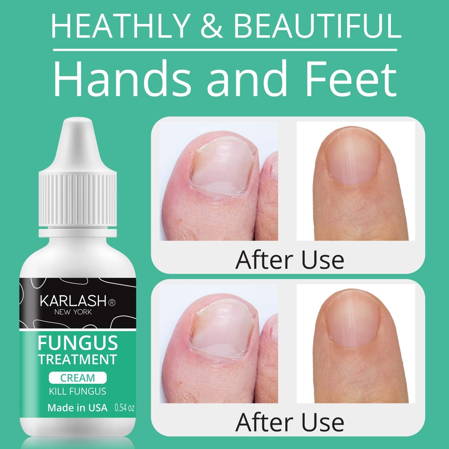 Karlash Nail Fungus Treatment for Toenail and Fingernail, Maximum Strength Antifungal Nail Treatment Made in USA Nail Fungus Skin Care 0.5 oz Cream